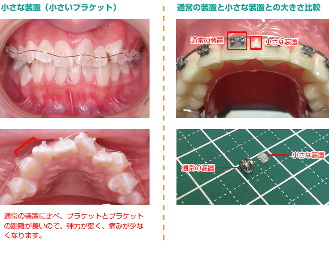 ブラケット比較