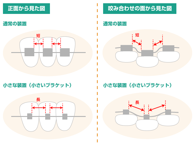 ブラケット比較